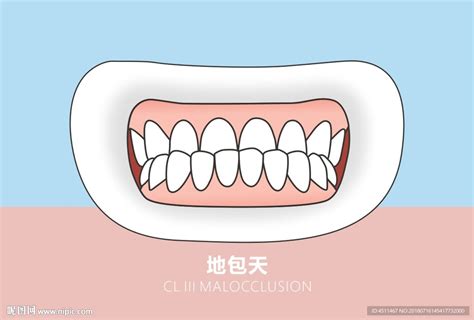 地包天牙齒|科普文：天包地和地包天有什麼區別